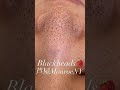 【毛穴】ブラックヘッド除去してストレス発散!!