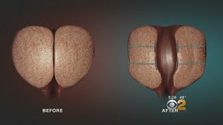 New Treatment Offers Hope For Men Suffering From Enlarged Prostates