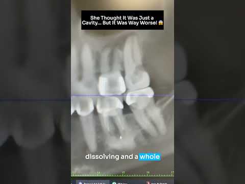 She thought it was just a cavity...but it was way worse! #shorts