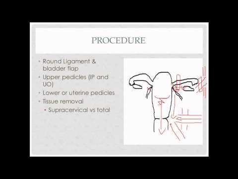 laparoscopic hysterectomy- description, indications and questions