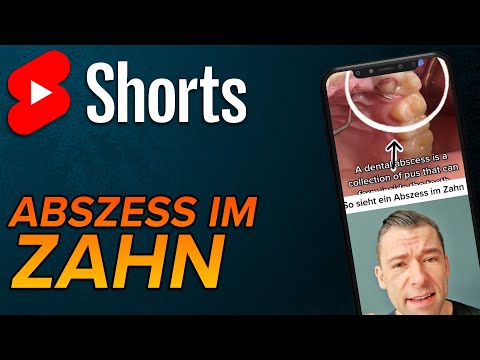 Video: Wer behandelt einen Abszesszahn?