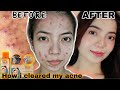 15 DAYS USING BEAUTY VAULT PREMIUM REJUVENATING SET+HONEST REVIEW (BYE PIMPLES&DARKSPOTS)| Celine C.