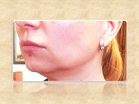 Обвисшие щеки: как подтянуть их и восстановить контур лица