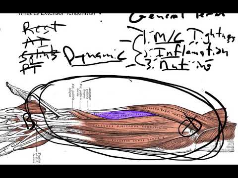 Wideo: Jak leczyć zapalenie ścięgna prostowników: 11 kroków