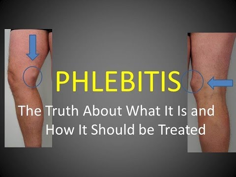 Video: Phlebitis: Simptome, Cauze, Prevenire și Multe Altele