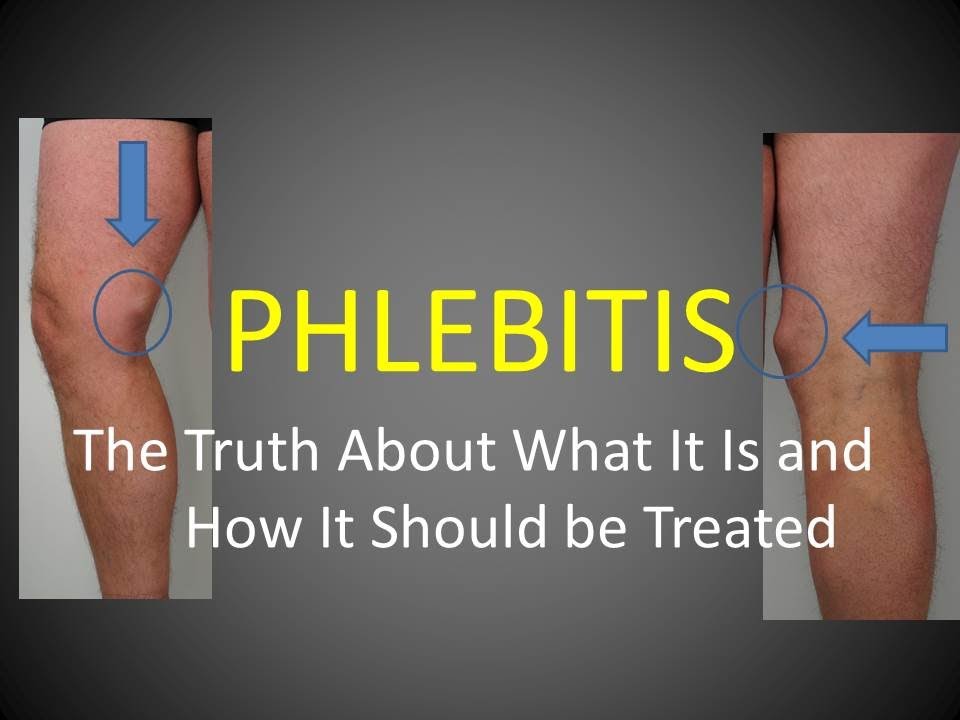 thrombophlebitis treatment