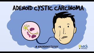 Adenoid Cystic Carcinoma