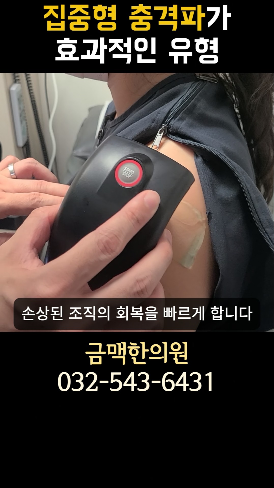 집중형 충격파가 효과적인 유형