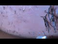 Plucking facial hair & ingrown hair 803 頬髭抜き(埋没毛あり)
