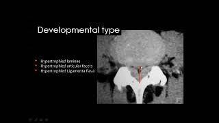 Imaging Of Spine Degenerative Diseases I Prof Dr Mamdouh Mahfouz In Arabic