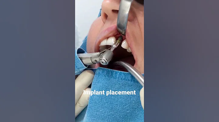 Full Implant placement procedure link in description #dentist #implant #teethtalk  #dentalimplants - DayDayNews