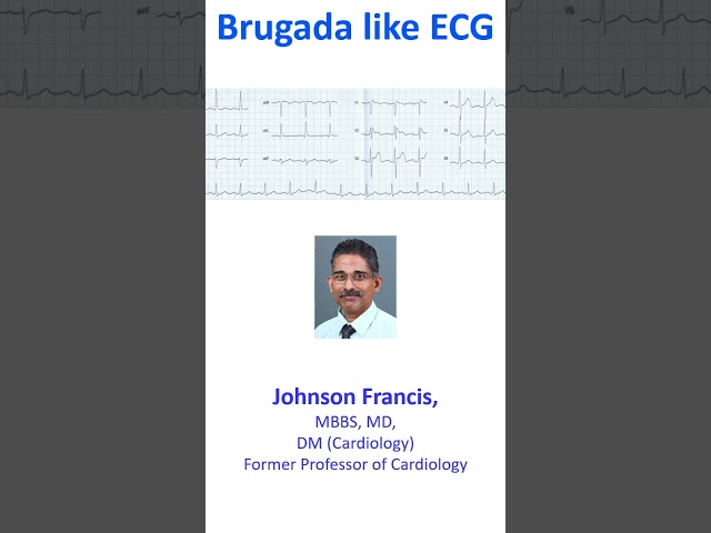 Brugada like ECG class=