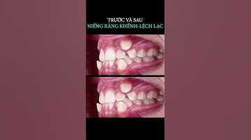 Trước và sau niềng răng khểnh - lệch lạc