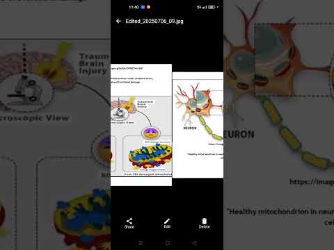 ليه بيحصل مرض باركنسون أهم الأسباب باختصار