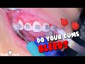 braces gum swelling/bleeding - Why and what to do - Tooth Time Family Dentistry New Braunfels