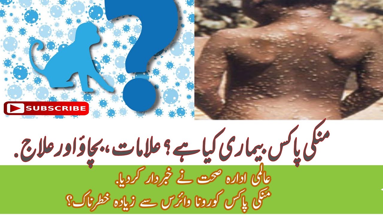 Monkey Pox Kia ha | 2024 Monkey Pox Could Be The New Pandemic