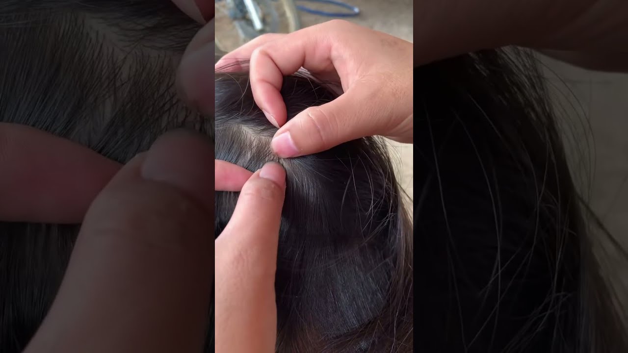 (Part 34) Lice Removal & Treatment Satisfying | Lice Popping