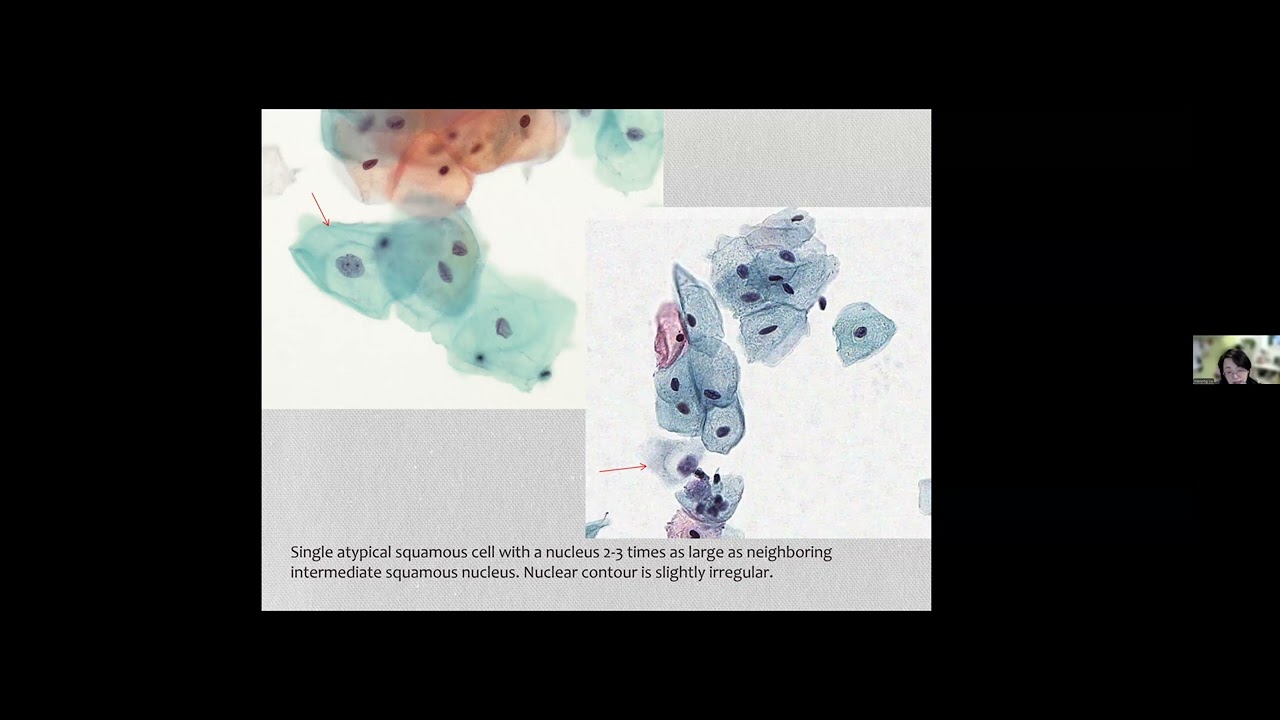 OPEN Mentoring Gyn Cyto Squamous Lesions