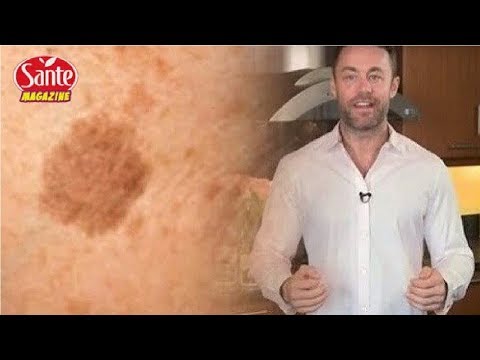 Vidéo: Comment un dermatologue élimine-t-il les taches brunes ?