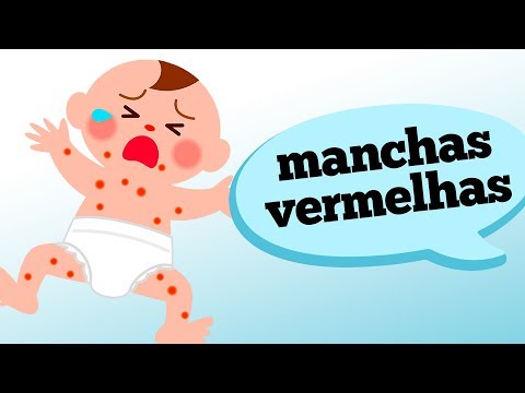 O QUE CAUSA MANCHAS VERMELHAS NO CORPO DE CRIANÇAS?