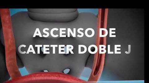 colocacion de cateter doble J