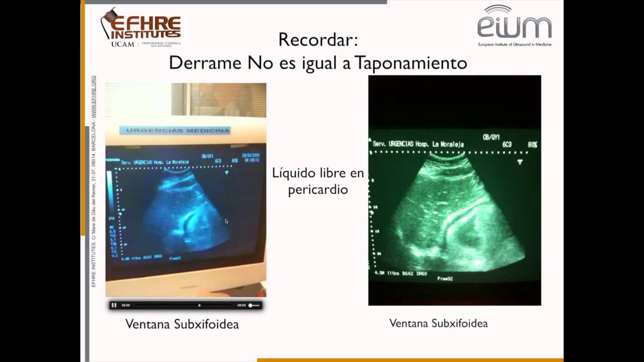 Exploración ecográfica siguiendo protocolo FAST
