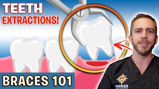 BRACES 101: Tooth Extractions For Braces! | Treatment Minute Talk!