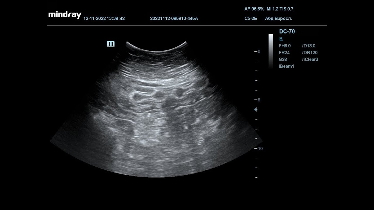 УЗИ ОБП. Отгадайте что это. Червь? Пациент проглотил четки? Просто ...