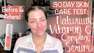 30 DAY SKIN TEST: NATURIUM VITAMIN C COMPLEX SERUM! Before & Afters! Acne Prone Skin - YouTube