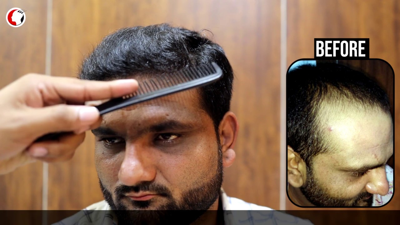 Baldness cure | How To Regrow Receding Hairline ? | Hair Transplant