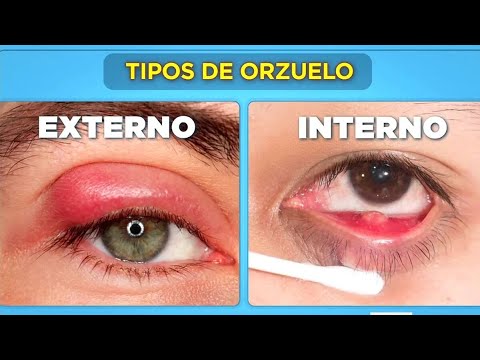 Como quitar un orzuelo del ojo