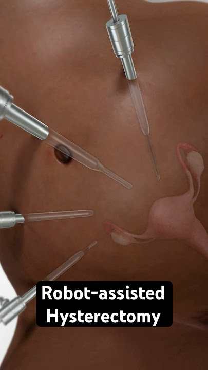 Removing the uterus (3D Animation)