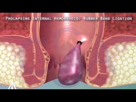 Удаление геморроя Лигирование латексными кольцами