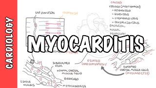 Myocarditis - causes, pathophysiology, investigation and treatment