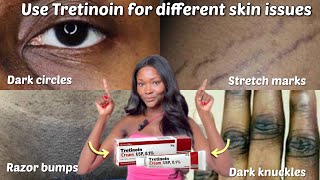 HOW TO USE TRETINOIN TO TREAT DIFFERENT SKIN ISSUES | Tretinoin tips for all round clear skin