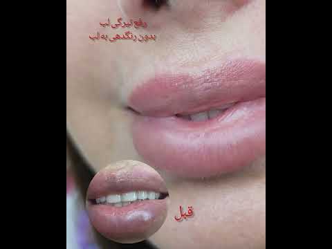 تینت لب برای رفع تیرگی بدون رنگپذیری لب