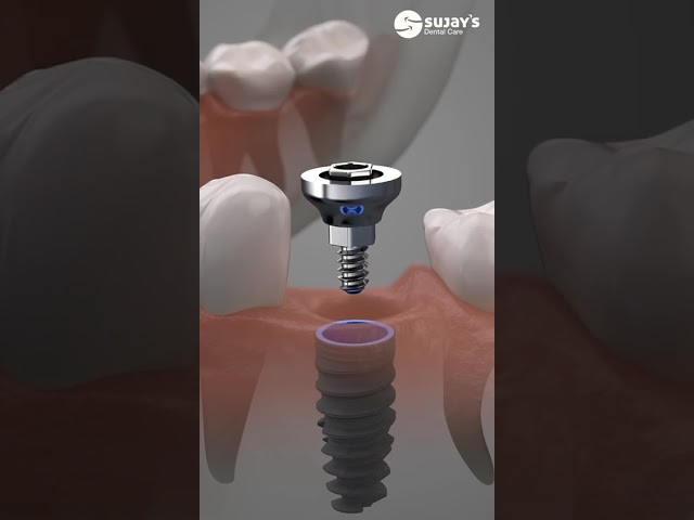 3D CBCT-Guided Dental Implants at Sujay’s Dental Care | Precision, Safety & Faster Healing