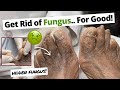 How To Kill Foot Fungus.. Naturally!