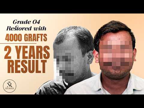 2 Years Later, His Hairline Looks NATURAL! 🔥 | Hair Transplant in Nashik | Marathi | New Roots
