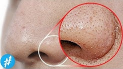 KOMEDO HITAM Di Hidung? Lakuin Hal Ini Untuk Membersihkannya Secara Cepat & Alami - Durasi: 6.26. 