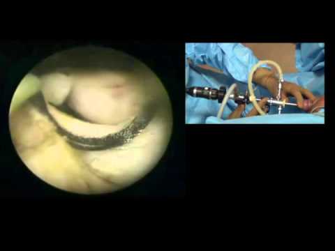video phone beyonce mp3 Bipolar turp 6 How to resect right lobe of prostatic adenoma