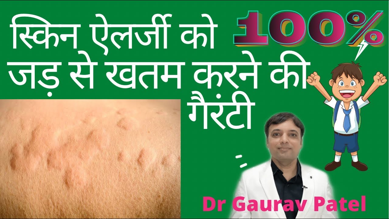 Skin allergy ko 100 khatam karne ki treatment at home How to cure