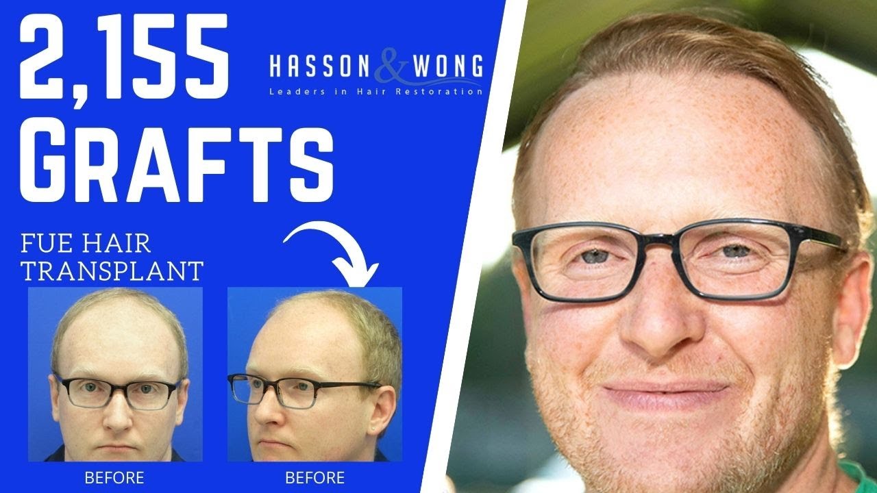 FUE HAIR TRANSPLANT 2155 GRAFTS | HASSON AND WONG