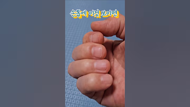 손톱에 이것 보이면 병원가세요!  #건강정보