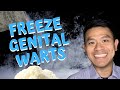 Freezing Genital Warts | How to Get Rid of Human Papilloma Virus  (HPV) using Cryotherapy