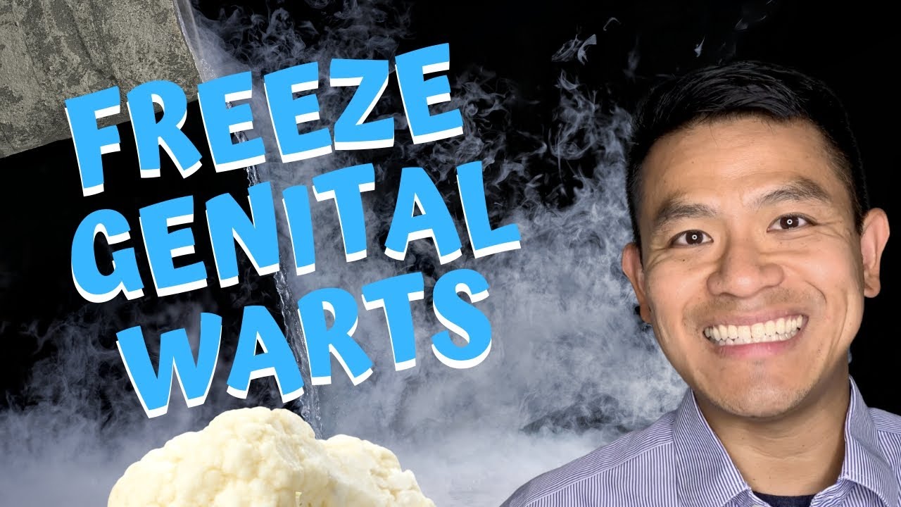 Freezing Genital Warts | How to Get Rid of Human Papilloma