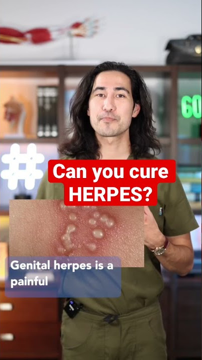 Can you CURE HERPES?
