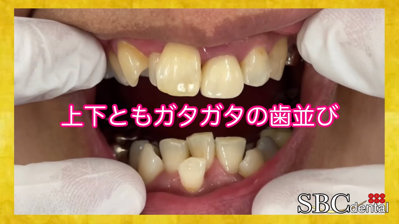 【上下ともガタガタ】上下前歯の歯並びをセラミックで美しく - YouTube