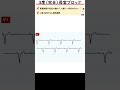 聞き流し1分心電図【完全房室ブロック】 #心電図検定