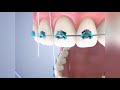 Complete Dental Braces Guide: Types & Benefits | Jain's Dental Villa